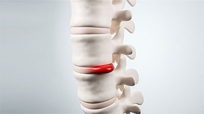 patient needs herniated disc chiropractor in Huntington, NY