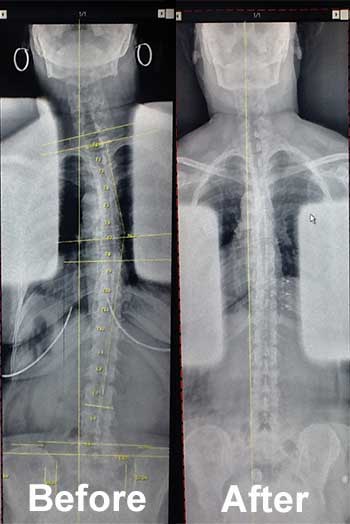 before and after xrays for chiropractic care in Huntington