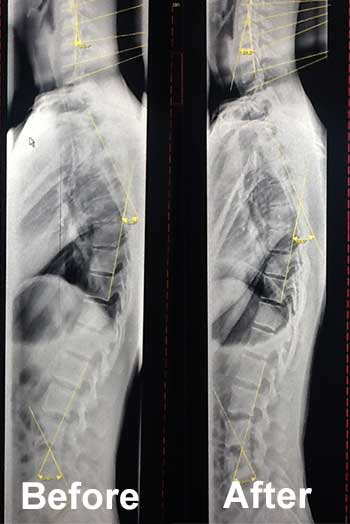 before and after xrays for chiropractic in Huntington