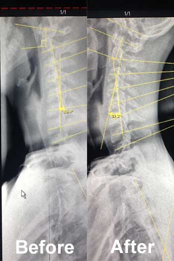 before and after xrays for chiropractor in Huntington