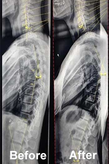 before and after xrays for gonstead chiropractic care in Huntington