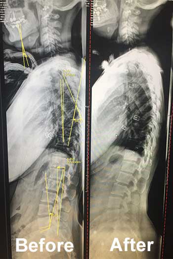 before and after xrays for gonstead chiropractic in Huntington