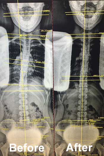 before and after xrays for gonstead chiropractor in Huntington