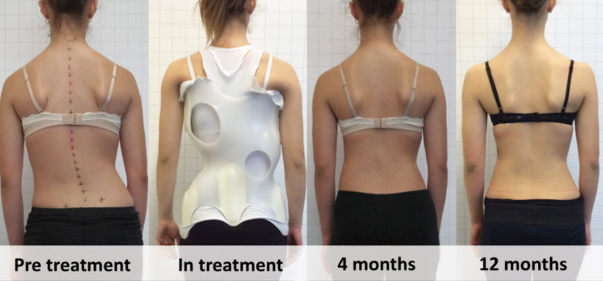 patient receiving scoliosis bracing in Huntington