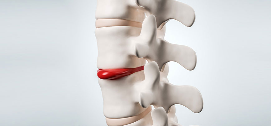 patient receiving herniated disc treatment in Huntington