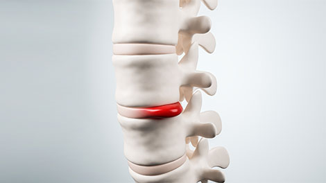 patient requiring disc injury treatment in Huntington
