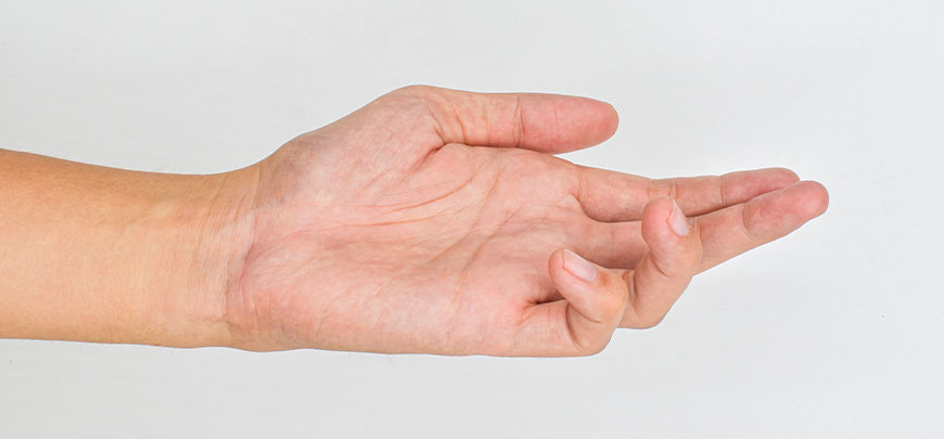 patient needing dupuytren contracture treatment in Huntington