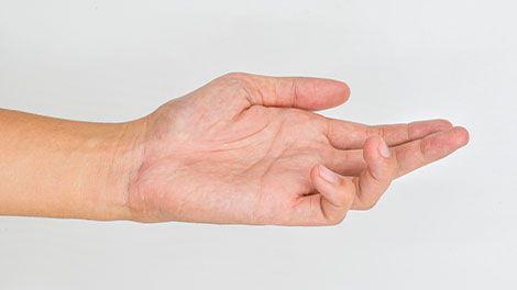 patient requiring dupuytren contracture treatment in Huntington