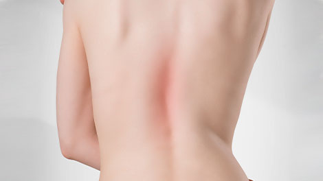 patient requiring scoliosis treatment in Huntington