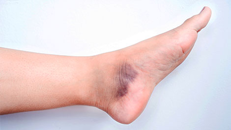 patient requiring sprain treatment in Huntington