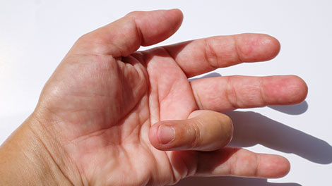 patient requiring trigger finger treatment in Huntington