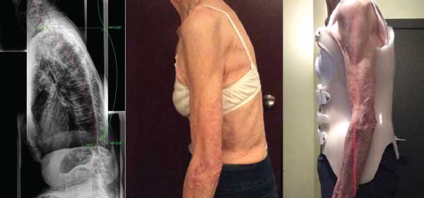 ScoliCare in Huntington