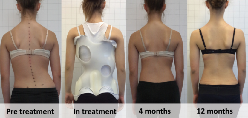 Scoliosis Bracing Huntington Chiropractors