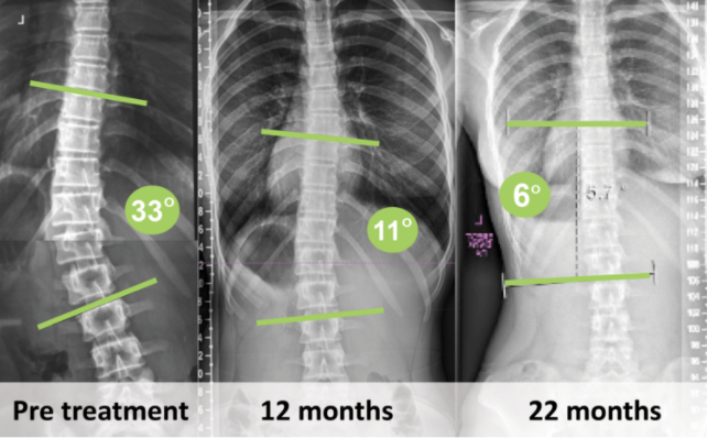 Scoliosis Care in Huntington