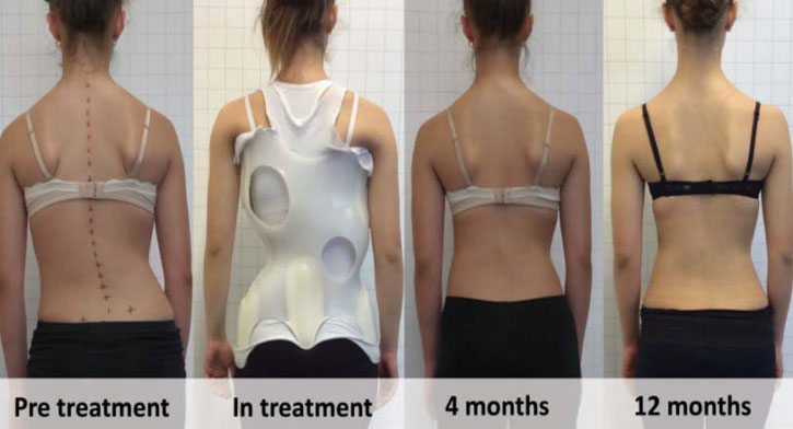 Scoliosis Bracing